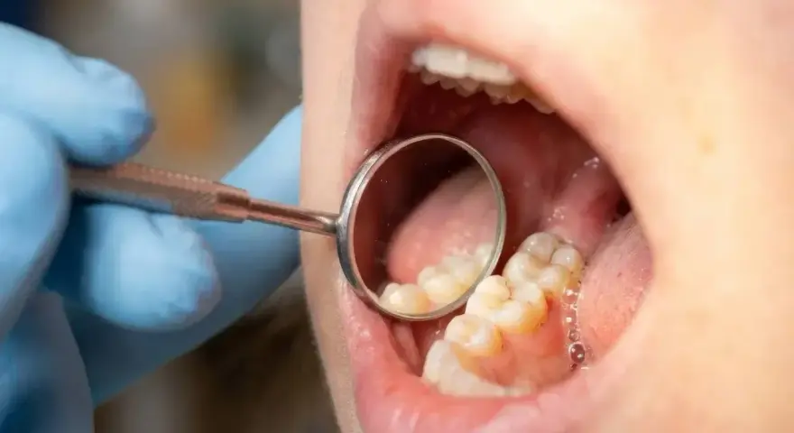 Dentysta bada zęby, na których widać początki próchnicy. Lustereczko dentystyczne odbija zniszczone szkliwo.