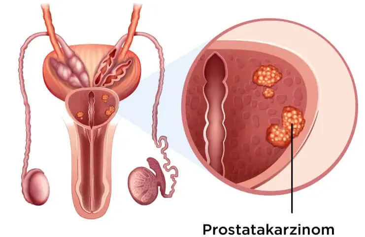 Was wird bei der Prostatakrebs Vorsorge gemacht? Wichtige Schritte erklärt