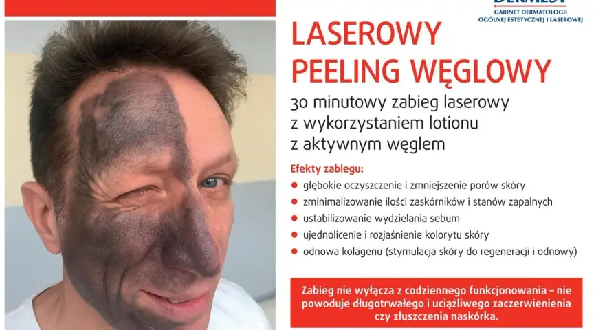 Przed i po laserowym peelingu węglowym: połowa twarzy pokryta czarną maską węglową, druga połowa czysta. Efekt odświeżenia i oczyszczenia.