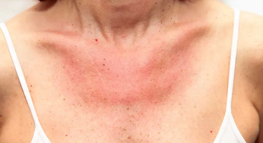 Här ser du hur soleksem kan se ut: röd, irriterad hud på bröstet och halsen, med små prickar.