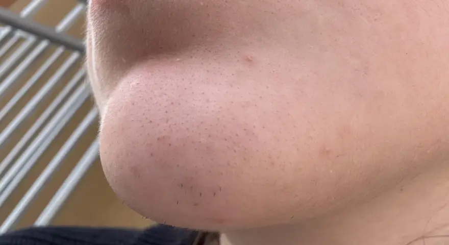 Primo piano del mento con pori visibili e alcuni punti neri. Si intravedono anche peli sottili e una piccola imperfezione.