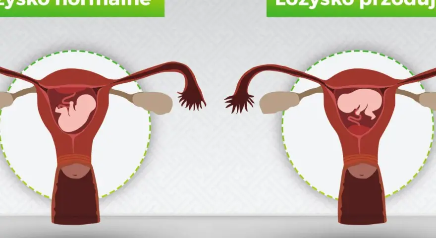Porównanie: łożysko normalne vs łożysko przodujące. Na obrazku widać macicę z płodem. W przypadku łożyska przodującego, łożysko znajduje się na przedniej ścianie macicy.