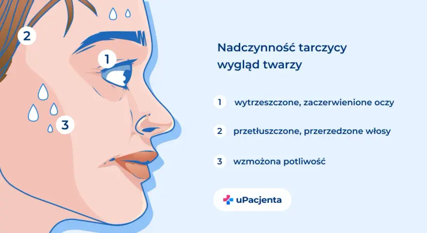 Nadczynność tarczycy objawia się wytrzeszczem oczu (1), przetłuszczonymi włosami (2) i wzmożoną potliwością (3).