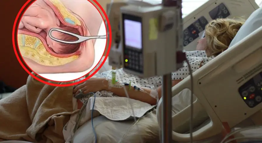 Ilustracja anatomiczna porodu kleszczowego obok kobiety w łóżku szpitalnym.
