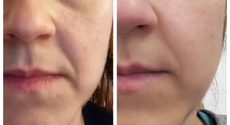 Comparaison avant/après : la peau semble plus lisse et les rides d'expression moins marquées grâce au bakuchiol.
