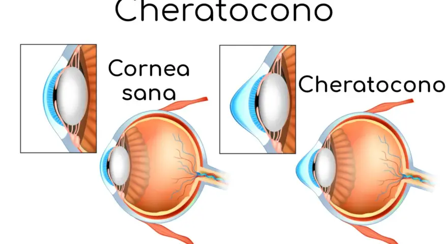 Confronto tra cornea sana e cheratocono. Anche a 50 anni, il cheratocono può alterare la forma dell'occhio.