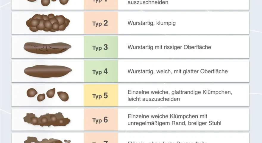 Typ 6 zeigt einzelne weiche Klümpchen mit unregelmäßigem Rand, was auf breiigen Stuhlgang hindeutet. Die Abbildung vergleicht verschiedene Stuhlformen.