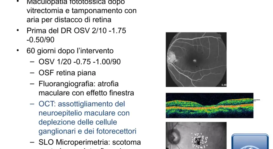 Caso 1: Maculopatia post-vitrectomia con bolla d'aria. Immagini OCT e SLO mostrano assottigliamento neuroepiteliale e scotoma.