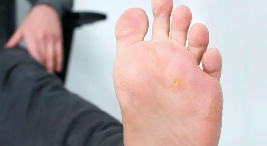 Gros plan sur un pied présentant un cors au pied infecté, visible sur la plante du pied, près des orteils.