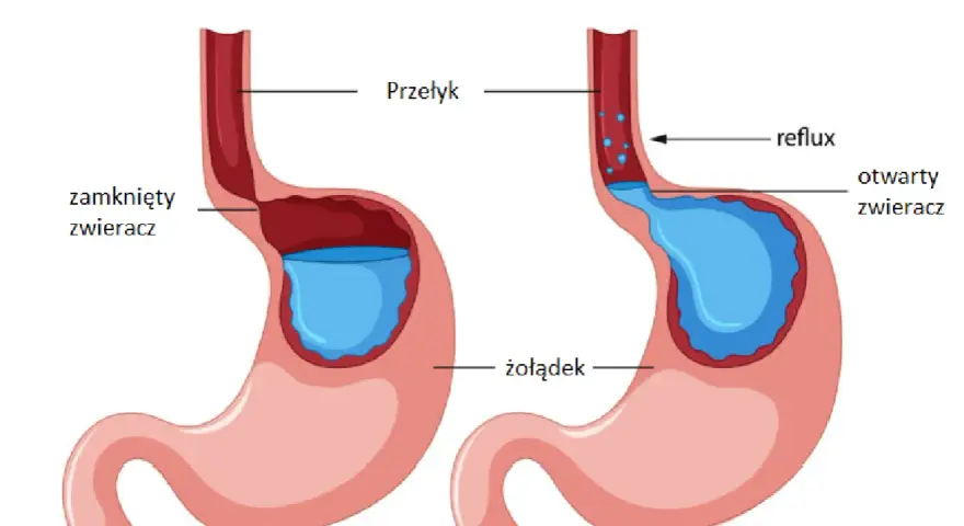 Ilustracja pokazuje refluks żołądkowo-przełykowy. Po lewej zamknięty zwieracz, po prawej otwarty, powodujący cofanie się treści żołądkowej do przełyku. Kawa może nasilać ten problem.