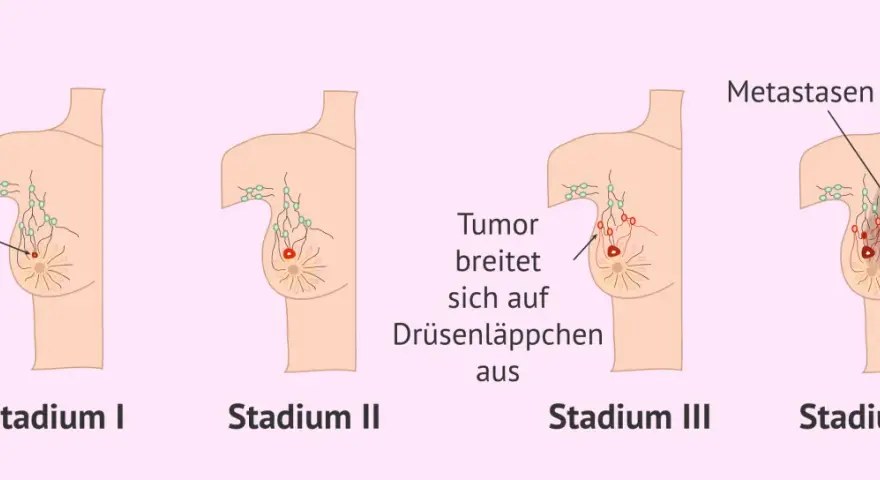 Illustrationen zeigen Stadien von Brustkrebs. Frühe Symptome wie ein Tumor werden sichtbar, bevor er sich ausbreitet. Spätere Stadien zeigen Metastasen.
