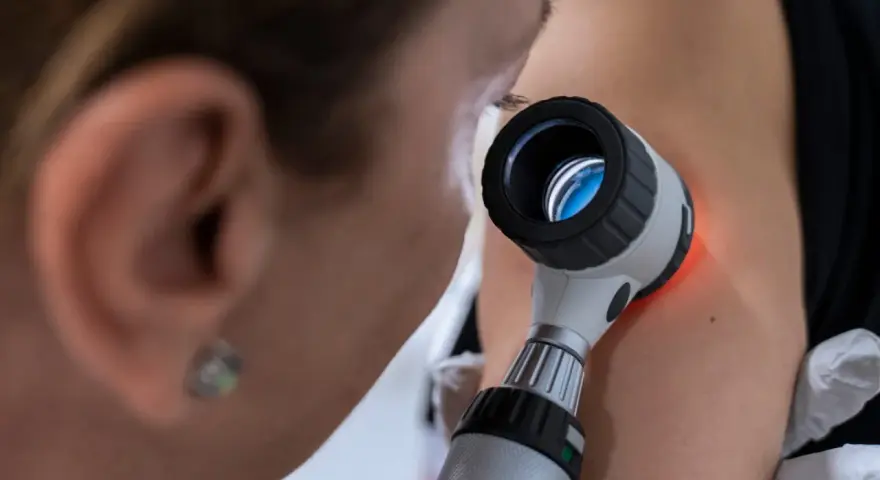 Dermatolog bada pieprzyk za pomocą dermatoskopu.