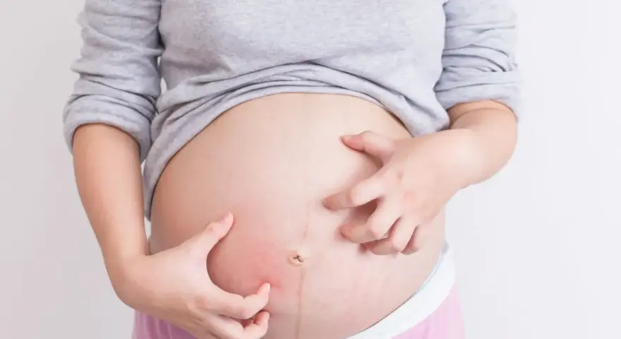 Kobieta w ciąży drapie brzuch z powodu swędzenia skóry.