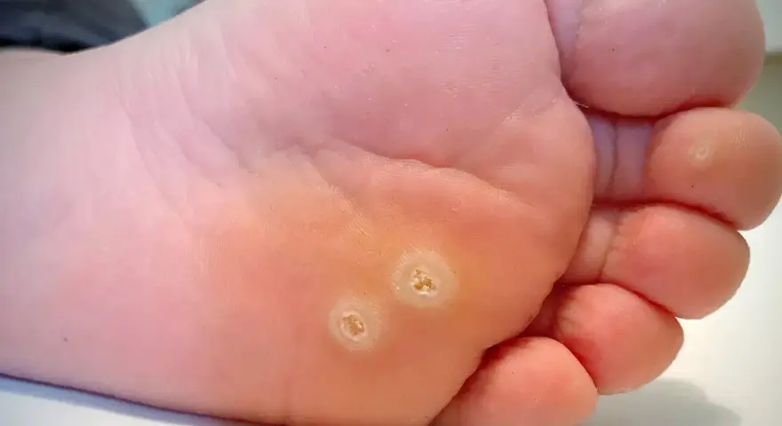 Gros plan sur la plante d'un pied, montrant deux verrues plantaires qui ne partent pas, avec une peau calleuse autour.
