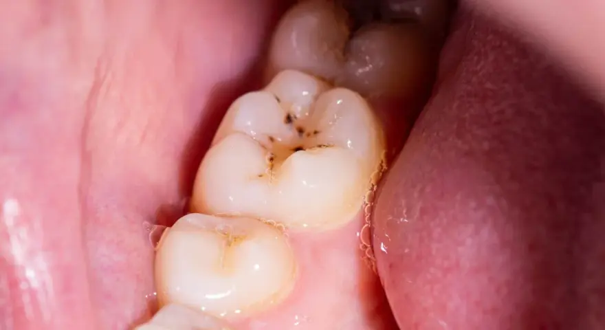 Jak wyleczyć próchnicę w domu? Kiedy to możliwe, a kiedy musisz iść do dentysty?