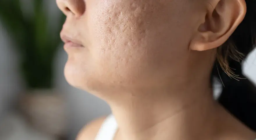 Primer plano de una mejilla con marcas de acné, mostrando la textura de la piel y la búsqueda de soluciones sobre como quitar marcas de acne.