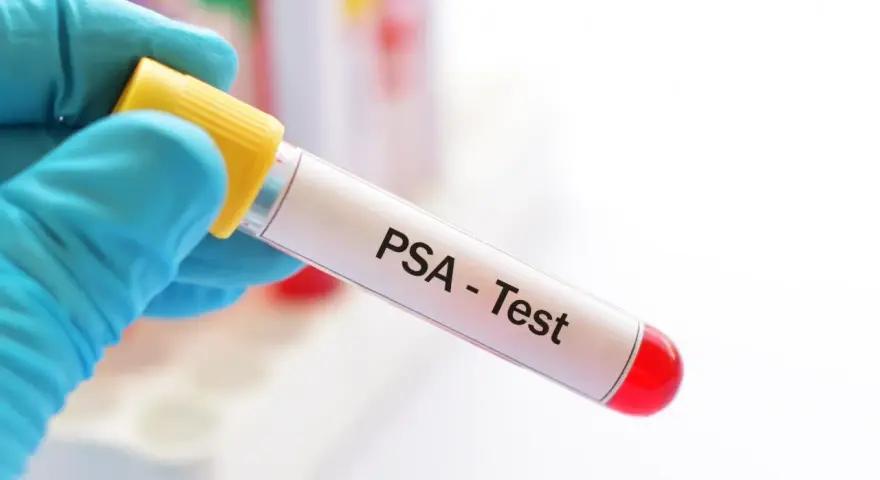 Blauer Handschuh hält Röhrchen für PSA-Test. Der PSA-Wert ist normal, was für die Gesundheit spricht.