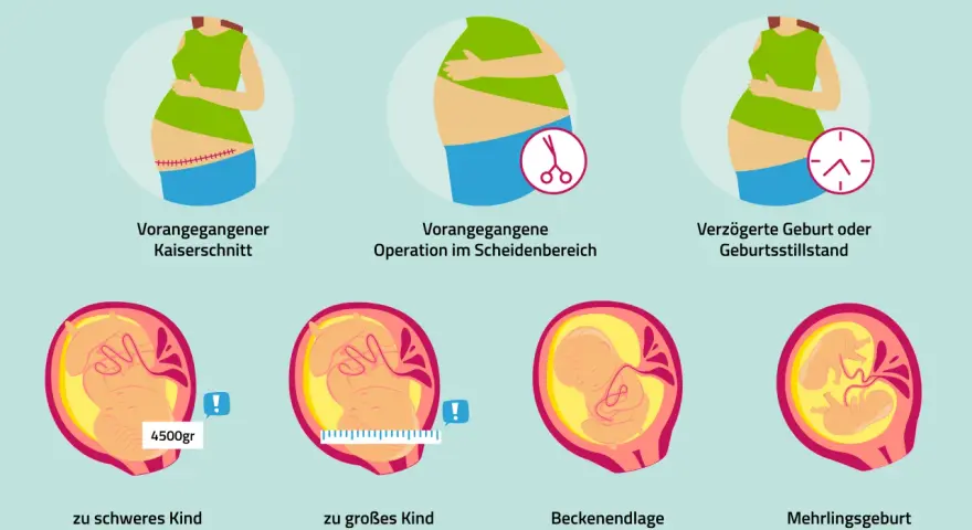 Bilder zum Kaiserschnitt-Ablauf: Narbe, OP im Scheidenbereich, verzögerte Geburt, zu schweres/großes Kind, Beckenendlage, Mehrlingsgeburt.