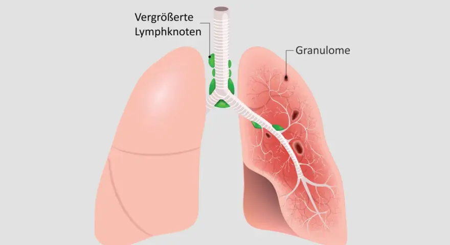 Lunge mit vergrößerten Lymphknoten und Granulomen, typische Sarkoidose-Symptome.