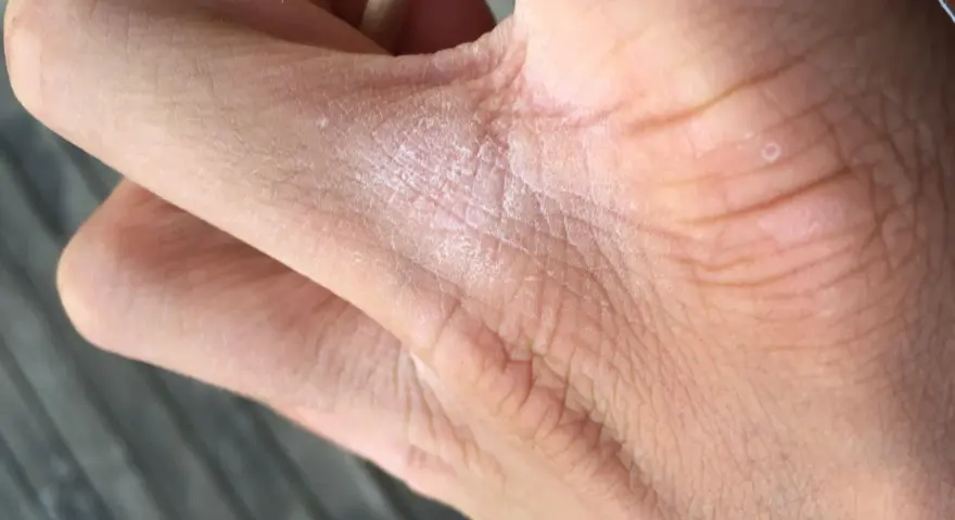 När huden är torr mellan fingrarna kan det kännas obekvämt. Här syns en närbild på en hand med torr hud och lite vita flingor.