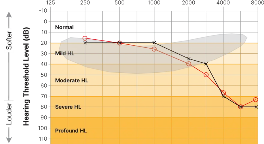 Graphique audiogramme montrant les seuils auditifs. On entend à partir de 0 dB. Les zones orange indiquent une perte auditive.