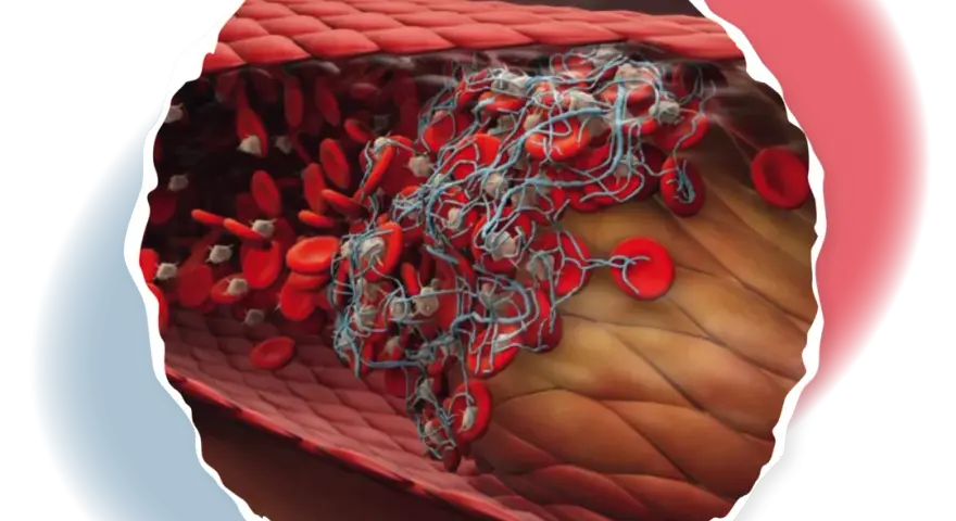 Polycythaemia vera symptome: Erkennen Sie die versteckten Warnsignale