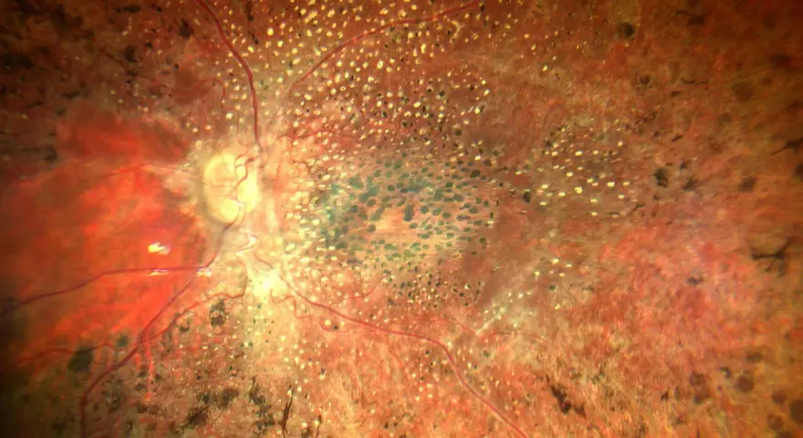 Retina con pigmentazione irregolare e vasi sanguigni, indicativa di amaurosi congenita di Leber. Ricerca di nuove cure in corso.
