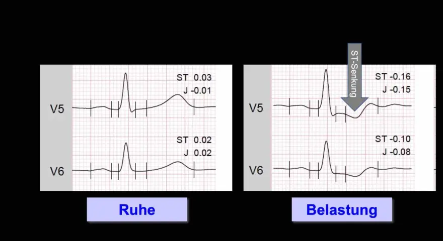 Vergleich von EKG-Aufzeichnungen in Ruhe und unter Belastung. Das Belastungs-EKG zeigt eine ST-Senkung, was auf pathologische Veränderungen hinweist.