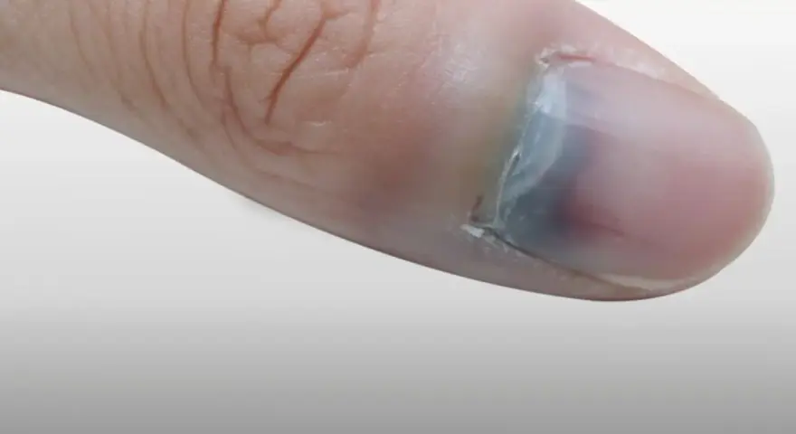 Gros plan sur un pouce avec un ongle bleu, signe d'un choc ou d'une ecchymose sous l'ongle.