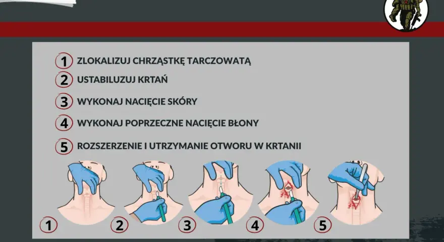 Ilustracja przedstawia procedurę konikotomii ratunkowej krok po kroku: lokalizacja chrząstki, stabilizacja krtani, nacięcie skóry i błony, rozszerzenie otworu.