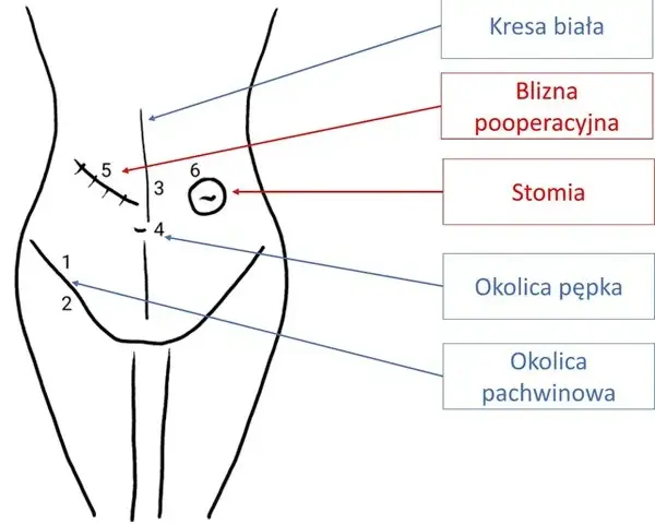 Przepuklina pachwinowa do jakiego lekarza? Kluczowe informacje dla pacjentów