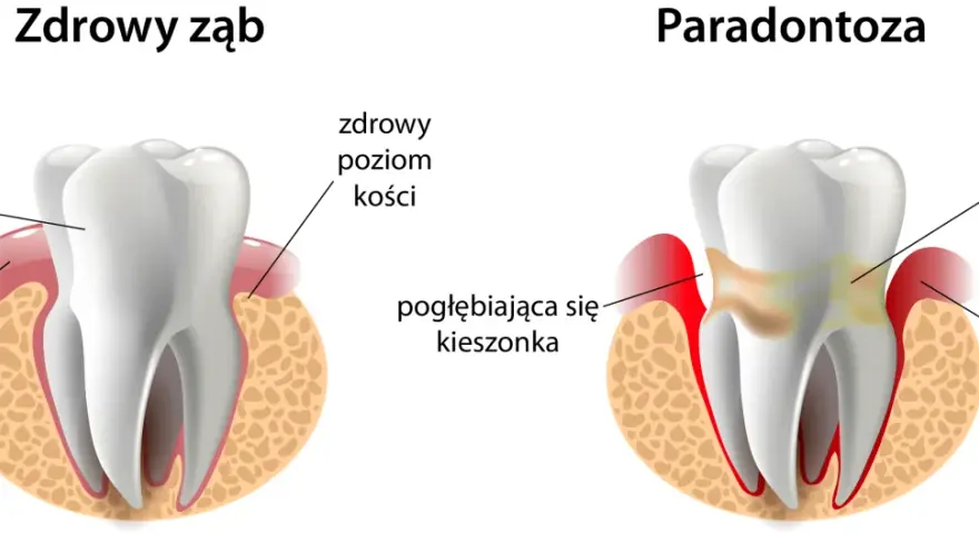 Zdrowe dziąsła: Jak dbać, by uniknąć paradontozy i krwawienia?