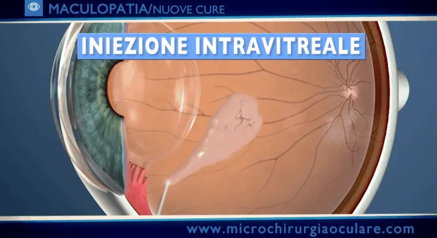 Iniezione intravitreale per trattare la maculopatia atrofica, mostrando una lesione sulla retina.