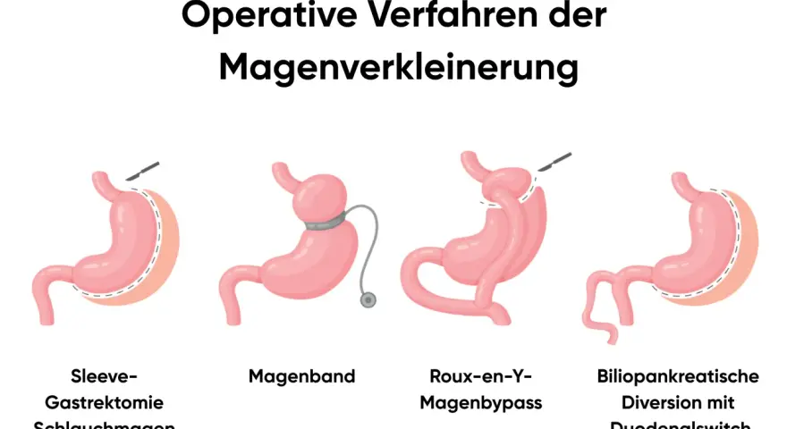 Illustrationen zeigen operative Verfahren zur Magenverkleinerung, darunter ein Magenbypass.