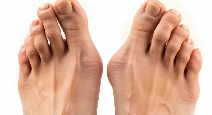 Två fötter med tydlig hallux valgus inflammation vid stortålederna.