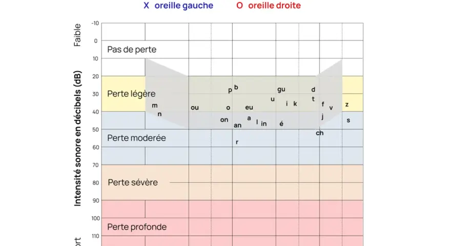 Audiogramme montrant les résultats d'un test auditif. Les zones indiquent le niveau de perte auditive, de "Pas de perte" à "Perte profonde", en fonction de la fréquence et de l'intensité sonore. Ce graphique est essentiel pour évaluer l'audition à tout...