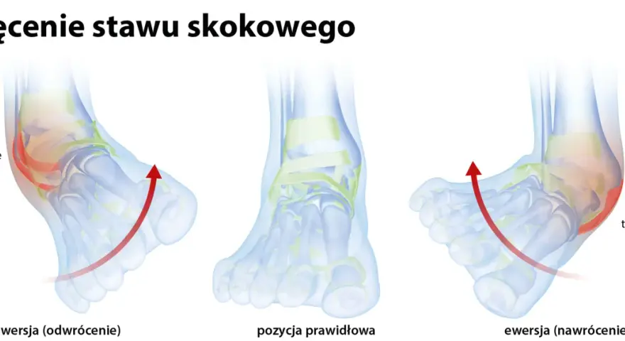 Ilustracja pokazuje inwersję stopy, czyli odwrócenie, które prowadzi do uszkodzenia więzadła skokowo-strzałkowego. Obok prawidłowa pozycja i ewersja.