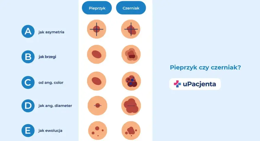 Porównanie cech pieprzyka i czerniaka: asymetria, brzegi, kolor, średnica i ewolucja.