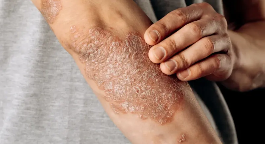 Psoriasis en los codos, con parches escamosos y enrojecidos. Una mano toca suavemente la piel afectada.