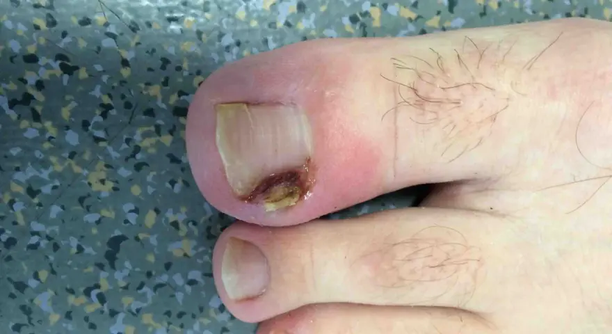 Gros plan sur un ongle de pied présentant un problème d'infection fongique, avec une partie de l'ongle décolorée et abîmée.