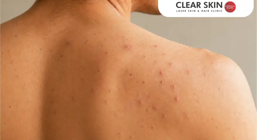 Close-up of shoulder acne. Learn how to get rid of shoulder acne overnight for clearer skin.