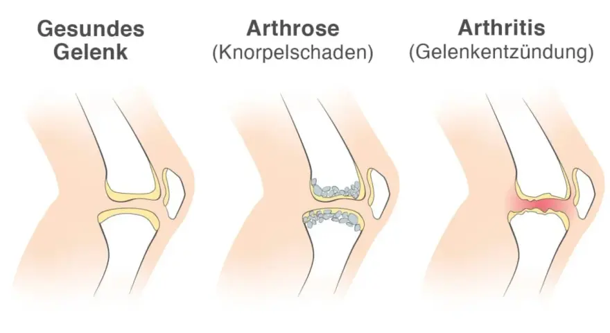 Vergleich von Gelenken: gesund, Arthrose (Knorpelschaden) und Arthritis (Gelenkentzündung). Arthritis zeigt eine Entzündung im Gelenk.