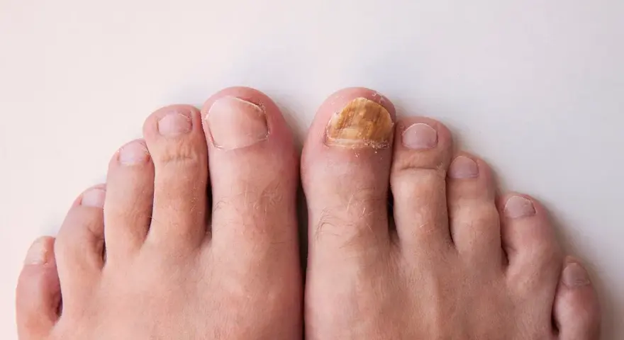 Gros plan sur des pieds, dont un ongle d'orteil atteint d'une mycose, illustrant un problème d'entretien ongles pieds.