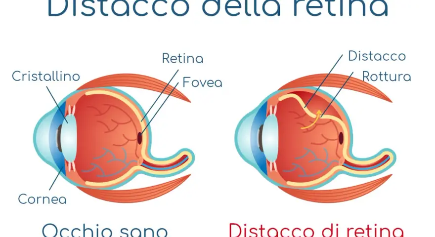 Confronto tra occhio sano e occhio con distacco della retina, mostrando la rottura e il sollevamento della retina.