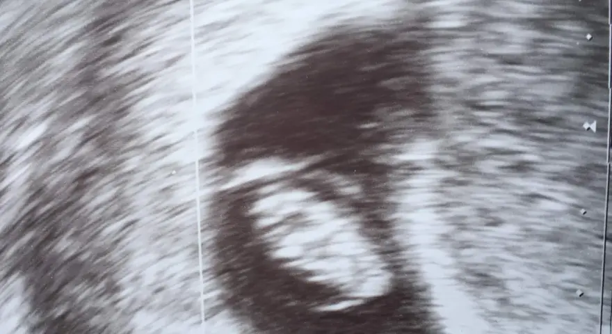 Ultraschallbild zeigt einen frühen Embryo. Die Ramzi-Methode könnte hier angewendet werden, um das Geschlecht zu erraten.