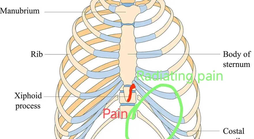 Anatomia klatki piersiowej z zaznaczonym wyrostkiem mieczykowatym i obszarem bólu.