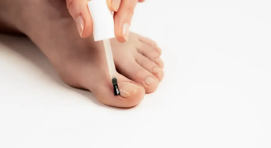 Application d'une huile essentielle sur un ongle incarné pour soulager la douleur et favoriser la guérison.