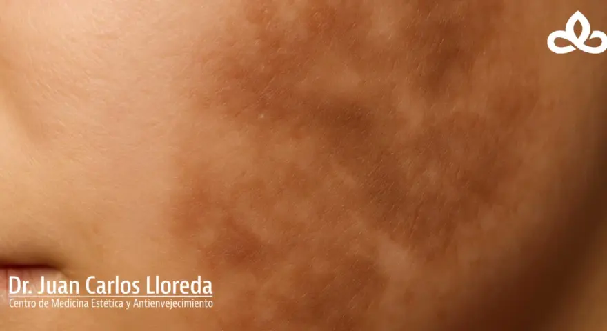 Piel con manchas irregulares, indicativo de hiperpigmentación postinflamatoria.