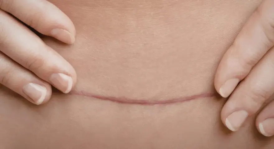 Dłonie delikatnie odsłaniają poziomą bliznę po cesarskim cięciu, przypominającą pionowy labret blizna.