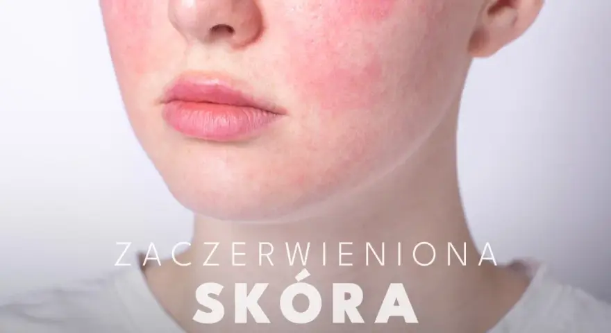 Widoczne zaczerwienienie na policzkach, które pokazuje, jak wygląda rumień. Skóra jest podrażniona i zaczerwieniona.